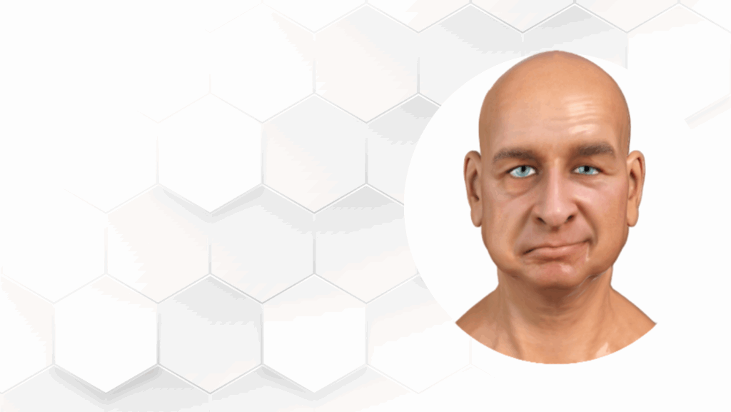Parálisis facial